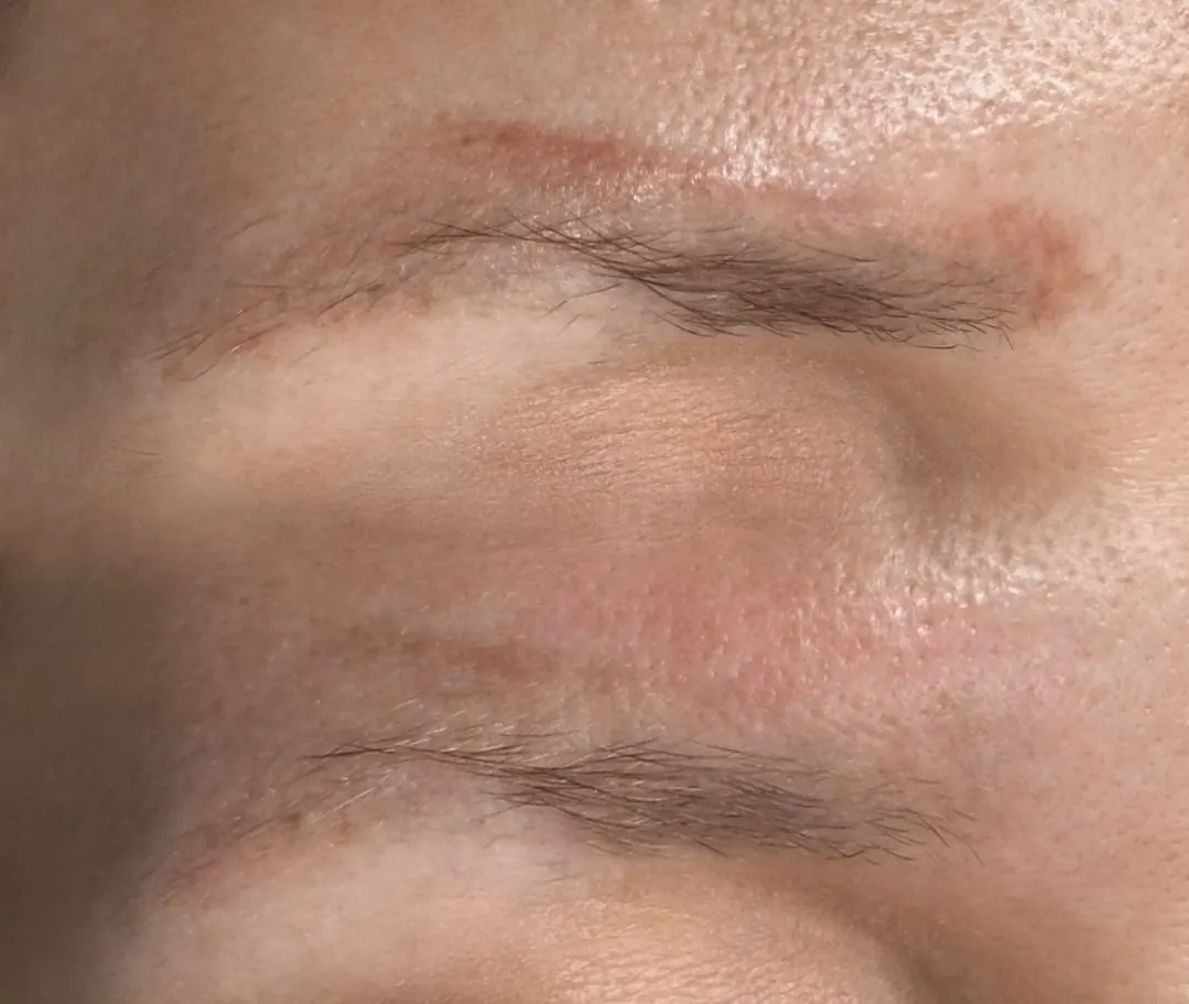 Remoción de pigmento en cejas, caso 2: comparación del pigmento anterior y la piel después del tratamiento