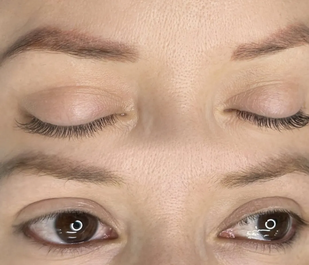 Remoción de pigmento en cejas, caso 4: comparación del pigmento anterior y la piel después del tratamiento